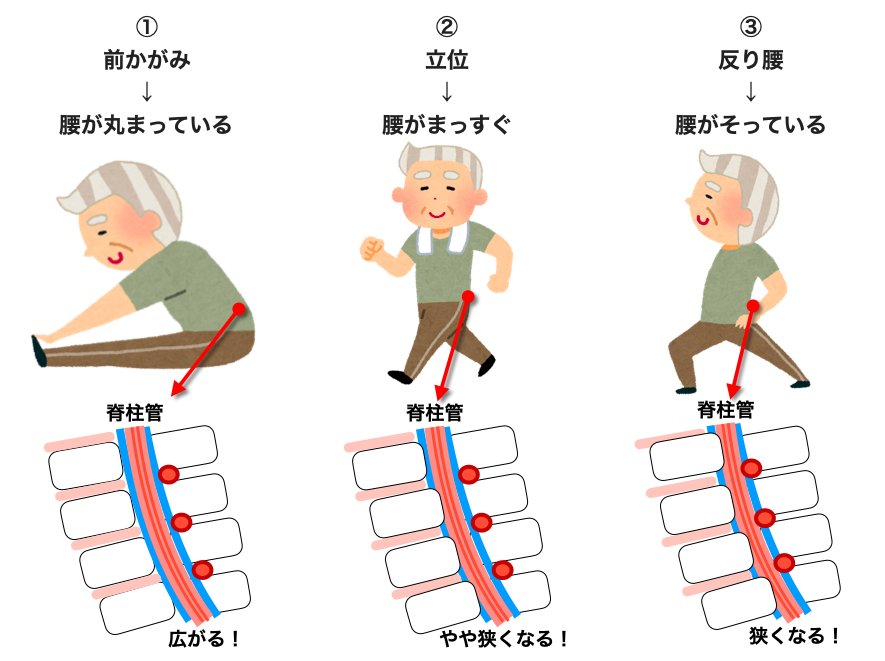 前かがみ　立位　反り腰の脊柱管の様子